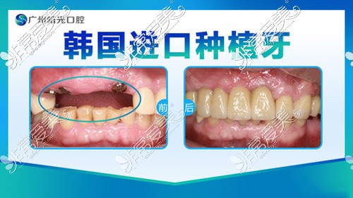 广州曙光口腔种植牙<span style=