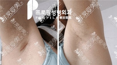韩国普罗菲耳隆胸疤痕修复