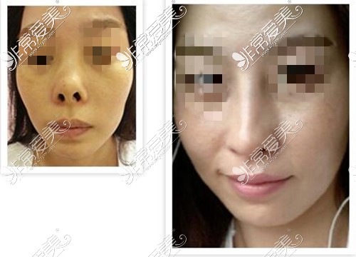 鼻修复华丽风自然风你喜欢哪种?推荐韩国鼻修复出名的医生!