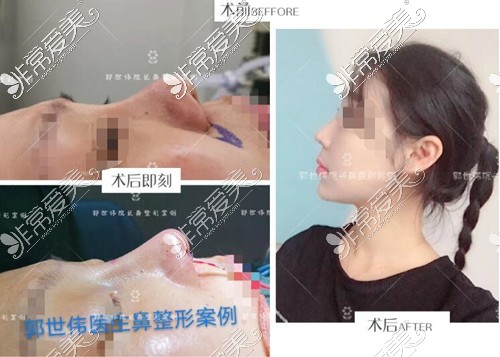 成都鼻修复医生哪个好？鼻子做个修复多少费用啊