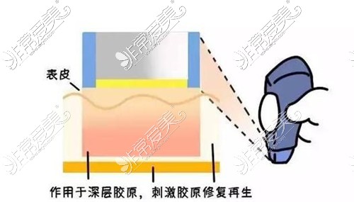 盘点广州热玛吉官方认证医院 哪家医院热玛吉口碑好