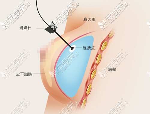 韩国THE整形外科胸部再造填充 韩国THE整形外科胸部再造填充