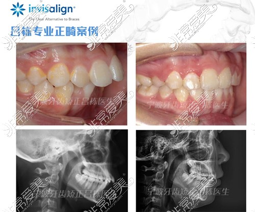 上颌前凸牙齿直立拔牙矫正日记