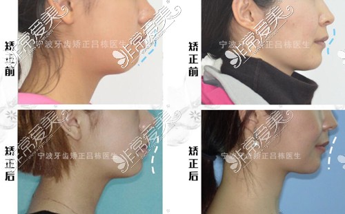 牙齿前突矫正真人日记