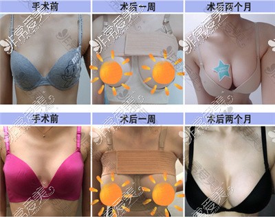 韩国NANA整形外科隆胸案例