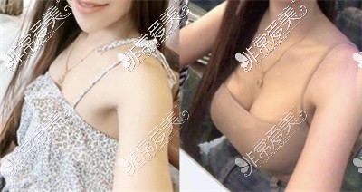 韩国VG百利酷整形外科隆胸案例