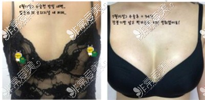 韩国PJS整形外科隆胸案例