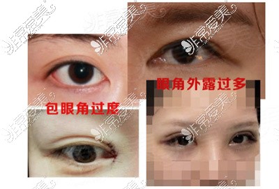 韩国修复内眼角可靠吗?韩国修复内眼角超好的医生排行汇总