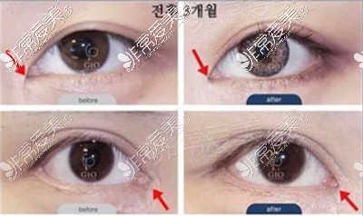 韩国修复内眼角可靠吗?韩国修复内眼角超好的医生排行汇总