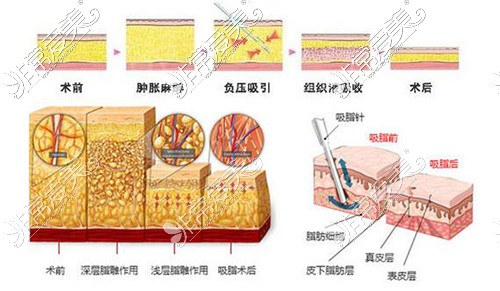 金华吸脂手术需要多少钱?公开金华整形医院吸脂费用价格！