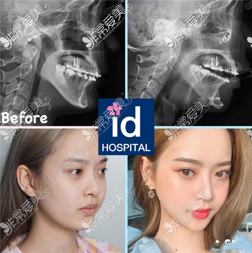 韩国ID整形医院磨骨案例