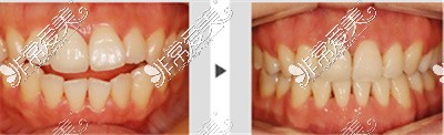 贵阳利美康陈娟医生正畸对比