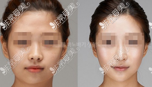 韩国面部不对称整形对比