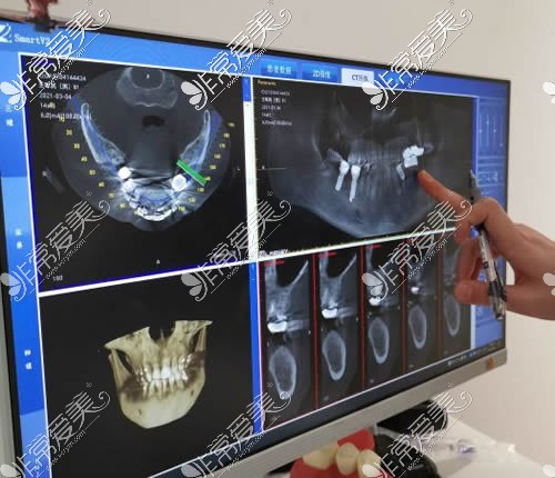 崇左阳光牙科数字化诊疗看牙科普