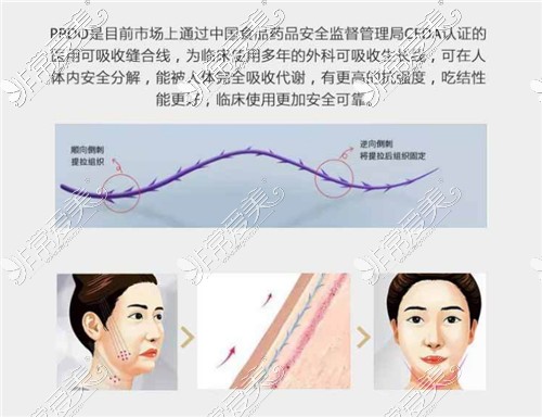 40岁做线雕还是热玛吉效果好？线雕跟热玛吉哪个效果好？