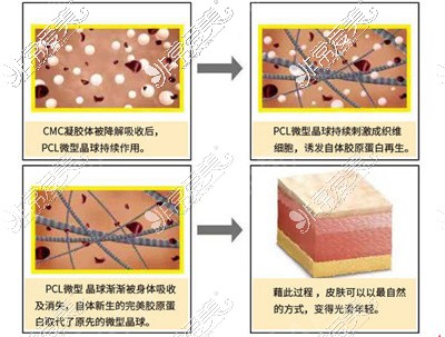 少女针是什么?它与玻尿酸区别是啥!另外少女针多少钱一针