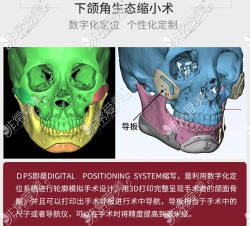 西安做下颌骨整形好的医院是哪家?西安专业磨骨医院在此!