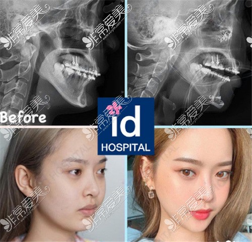 韩国ID医院面部轮廓案例对比