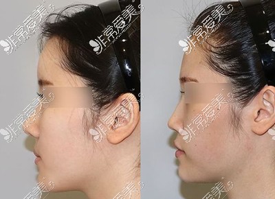 韩国CH愈合整形外科鼻整形案例