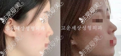 韩国德丽珍整形外科鼻整形案例