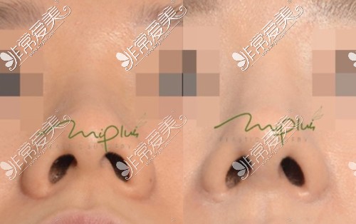 韩国Miplus整形外科鼻整形案例