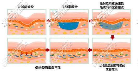 童颜针注射特点分析