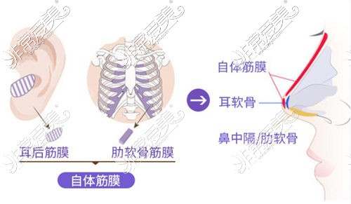 广州壹加壹隆鼻手术