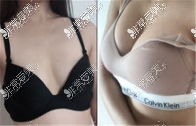 韩国原辰整形外科隆胸