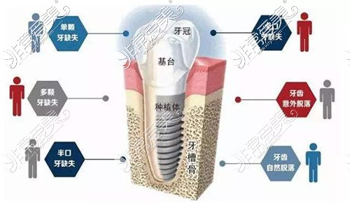 种植牙适应症分析