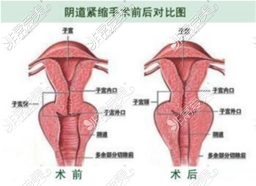 阴道紧缩前后手术对比图