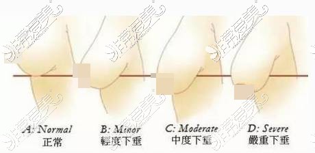 胸部下垂程度对照表