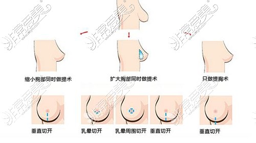 乳房下垂矫正方法