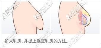 乳房扩大上提手术