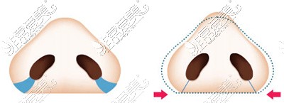 蒜頭鼻福鼻矯正手術(shù)