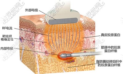 扒皮贴:溶脂和抽脂的区别是什么?原理+价格+效果各不同!