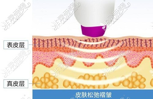 电波拉皮抗衰老卡通照片