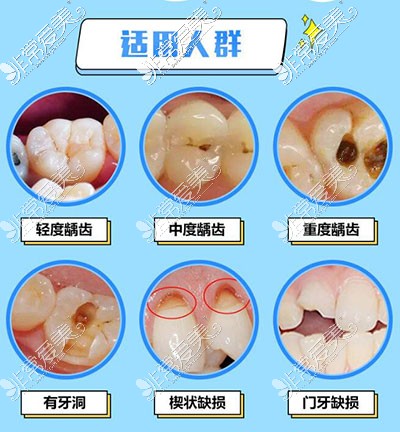 补牙适合哪些人群选择