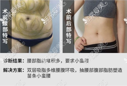 常州施尔美整形腰腹吸脂<span style=