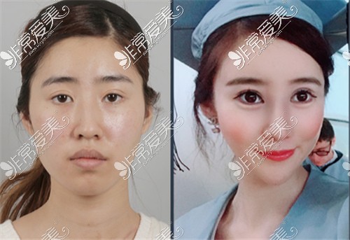 韩国ID整形医院双鄂手术案例