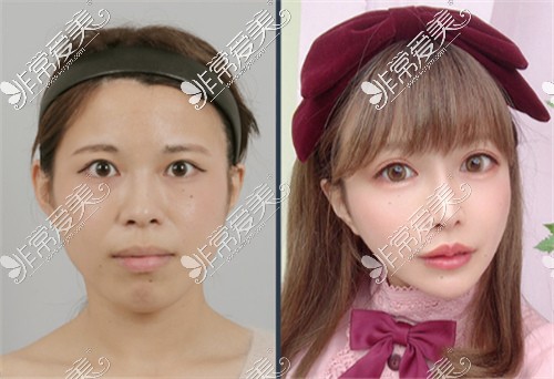 韩国ID整形医院双鄂手术前后对比图
