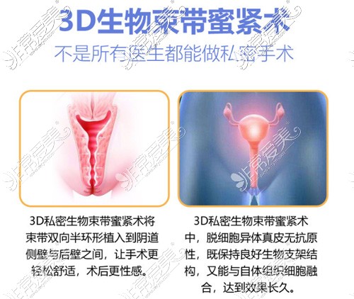 3d束带缩阴手术的危害和原理分享,分析生物束带紧缩术贵不!