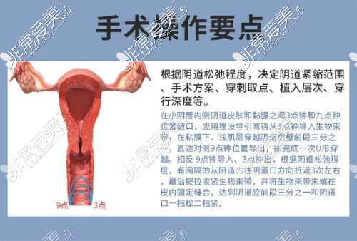 3d束带缩阴手术要点