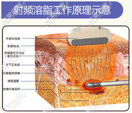 射頻溶脂工作原理圖示