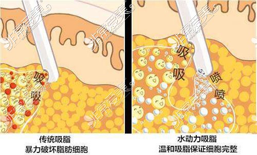 惠州吸脂手术一般多少钱？细数惠州各正规整形抽脂价目表