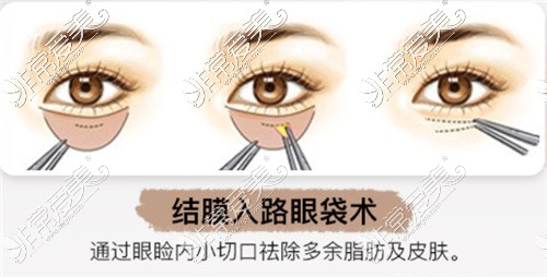 杭州艺星祛眼袋手术方式