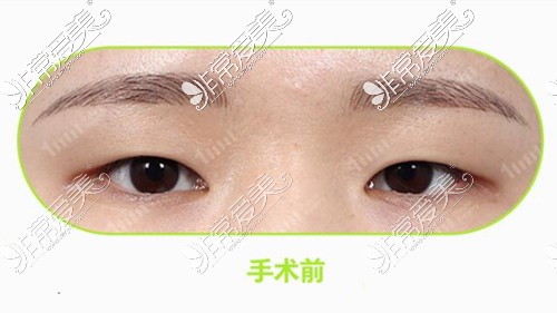 韩国1mm医院割双眼皮技术好吗