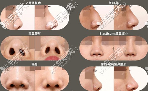 韩国原辰鼻修复、隆鼻效果怎么样