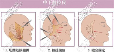 小切口拉皮卡通图