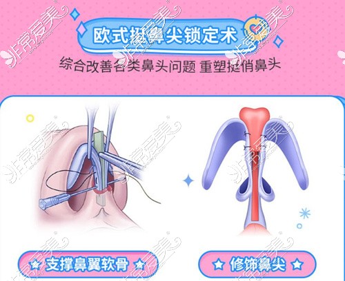 中山垫鼻子功课分享：这些正规整形医院隆鼻各有特色！