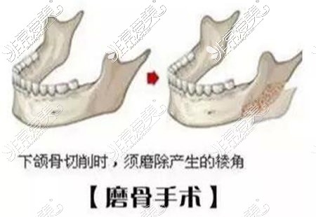 下颌角磨骨手术示意图